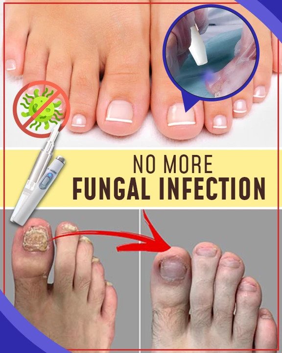 Anti-svampe behandlingssæt med blåt lys - Billede 3